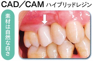 保険適用で「白い歯」に