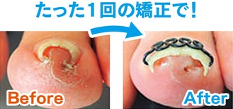 革新的巻き爪矯正で注目