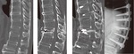 70代男性　第12胸椎椎体骨折　セメントによる椎体形成術とスクリューによる脊椎後方固定術施行左：発症時　中：発症10か月後　右：術後１年