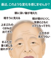 日常に支障きたす眼瞼下垂