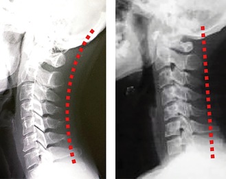 「ストレートネック」な頸椎（右）と自然なカーブの頸椎（左）の画像「適切な施術で回復します」（院長）